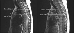 Evaluation of Vertebral Level of Sternal Angle and Sternal Notch Using MRI