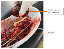 Placental Chorioangioma – A Benign Vascular Tumor of Placenta